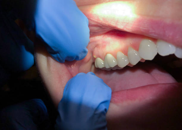 Best Emergency Root Canal Treatment in South San Francisco, CA