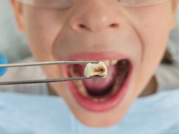 Best Emergency Dentist for Knocked-Out Tooth in South San Francisco, CA